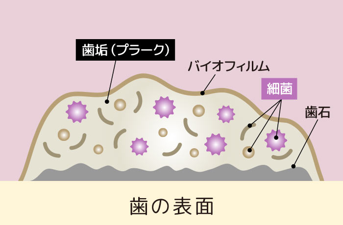 プラークには菌がいっぱい